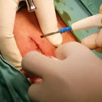 خالبرداری لیپوم منگوله تگ زگیل میخچه توسط پزشک|خدمات آرایشگری و زیبایی|تهران, شهرک غرب|دیوار