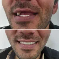 دندان مصنوعی|خدمات آرایشگری و زیبایی|آبیک, |دیوار