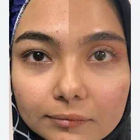 آف ویژه بلفاروپلاستی توسط پزشک متخصص جراحی زیبایی
