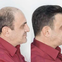 فروش و نصب پروتز موی طبیعی و چسب پروتز ریموور