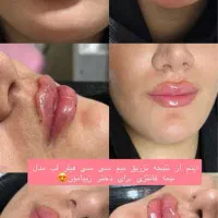 ژل وبوتاکس فیلرمزوپی ارپی آنزیم هایفوبلفاروپلاستی|خدمات آرایشگری و زیبایی|تبریز, |دیوار