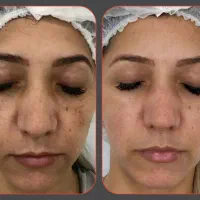 تخصصی لک،جوش،منافذ،جوانسازی