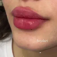 آموزش و خدمات تزریق فیلر لب و بوتاکس