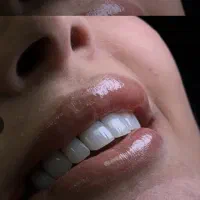 تخفیف ویژه کامپوزیت دندان ژل و بوتاکس قیمتها واقعی