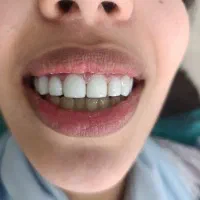 روکش دندان ، کامپوزیت|خدمات آرایشگری و زیبایی|تهران, تهرانسر غربی|دیوار