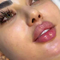 بوتاکس ژل لب گونه چانه فک پر کردن صورت لاغر نخ مزو|خدمات آرایشگری و زیبایی|قم, زنبیل آباد|دیوار