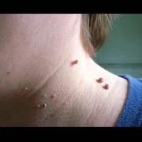 برداشتن انواع خال وزیگل با دستگاه لیزر پیشرفته|خدمات آرایشگری و زیبایی|ارومیه, |دیوار