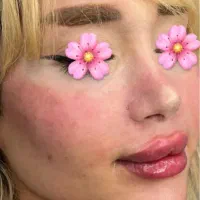 بوتاکس و ژل تخصصی با مواد اصل و تخفیف ویژه