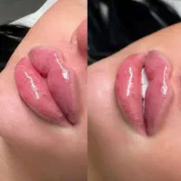ژل و بوتاکس فیلر چربی مزو|خدمات آرایشگری و زیبایی|مشهد, طلاب|دیوار