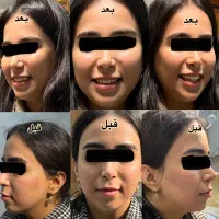 ژل بوتاکس نخ لیفت (توسط پزشک)