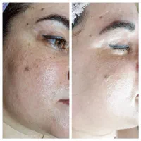 فشیال حرفه ای درمان ۷۰ درصدی در یک جلسه