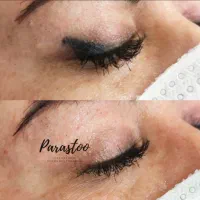 ریموو تتو بدون زخم و نقاهت