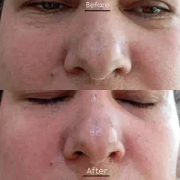 پاکسازی صورت فشیال تخفیف عید