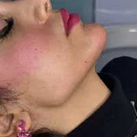 تزریق ژل و بوتاکس لیفت نخ جدیدترین متد مطب زیبایی|خدمات آرایشگری و زیبایی|کرج, گوهردشت|دیوار