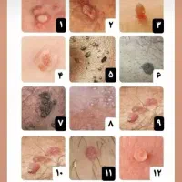 ازبین برندن زگیل تناسلی درکمتراز۱۵روزوبهبودی کامل|خدمات آرایشگری و زیبایی|گرگان, |دیوار