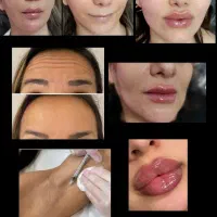 فیلر وبوتاکس