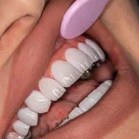 کامپوزیت،لمینیت،ایمپلنت اقساط با چک صیادی بدون سود