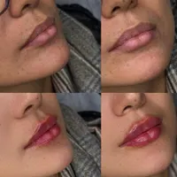 تخفیفات ژل و بوتاکس در مطب پزشک|خدمات آرایشگری و زیبایی|سنندج, |دیوار