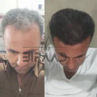 کاشت مو ، ریش ، ابرو