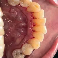 جرم گیری و بروساژ دندان