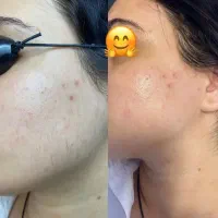 جدیدترین دستگاه لیزر 2025 در شهر جم|خدمات آرایشگری و زیبایی|جم, |دیوار