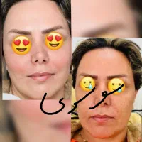 روشن کننده و رفع هرنوع مشکل پوستی بدون بازگشت|آرایشی، بهداشتی، درمانی|لردگان, |دیوار