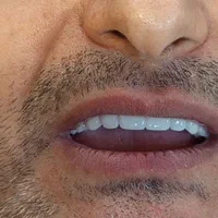 دندان مصنوعی متحرک|آرایشی، بهداشتی، درمانی|تهران, تهرانسر شرقی|دیوار