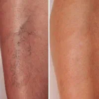 واریس درمانی بدون تزریق