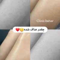 لیزر بدن تضمینیِ تضمینی با سفیدکنندگی بدن|خدمات آرایشگری و زیبایی|گرگان, |دیوار