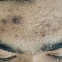 جای جوش و ابله و لک جوش