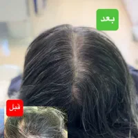 پی آر پی مو و صورت تخفیف ویژه پی ارپی بعدازکاشت مو|خدمات آرایشگری و زیبایی|قزوین, |دیوار