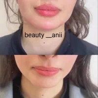 جشنواره ژل لب روسی و بوتاکس|خدمات آرایشگری و زیبایی|فردیس, شهرک ارم|دیوار