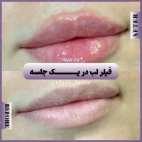 تخفیفات ۵۵٪ دکتر ملائی ،مزو بوتاکس فیلر ژل لب روسی|خدمات آرایشگری و زیبایی|مشهد, کوثر|دیوار