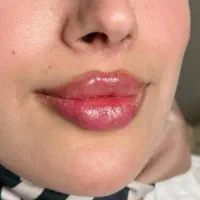 تخفیفات ژل وبوتاکس ومزوژل به مناسبت یلدا|خدمات آرایشگری و زیبایی|قم, زنبیل آباد|دیوار