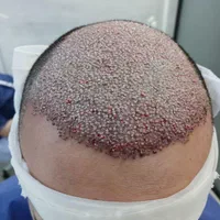 کاشت مو  تخصصی  تخفیف ۲۰درصدی مارو از دست ندهید|خدمات آرایشگری و زیبایی|اهواز, کیانپارس |دیوار