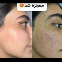 کرم سفید کننده شب (آنتی استاین )ترکیب آمپولی|آرایشی، بهداشتی، درمانی|بم, |دیوار