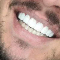 کامپوزیت دندان