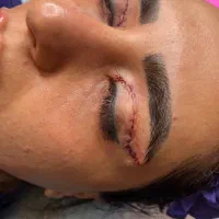 تخفیف ویژه جراحی پلک(بلفاروپلاستی)ژل لب یک میلیون|خدمات آرایشگری و زیبایی|مشهد, فردوسی|دیوار