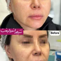 جشنواره تخفیفی اندولیفت و بلفارو