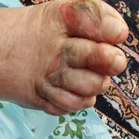 درمان زخم دیابت و زخم بستر سوختگی و عفونی|خدمات آرایشگری و زیبایی|کرج, باغستان|دیوار