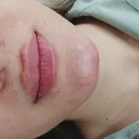 تخفیف ژل و بوتاکس