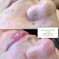 فیشیال و پاکسازی تخصصی ودرمان مشکلات پوستی(تخفیف)|خدمات آرایشگری و زیبایی|گرگان, |دیوار