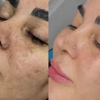 پاکسازی پوست صورت تخصصی (فیشیال vip)|خدمات آرایشگری و زیبایی|سنندج, |دیوار
