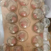 حجامت و بادکش گرم و سرد