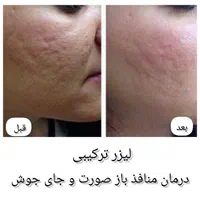 کیوسوئیچ، ریموو تتو،هایفو، جوانسازی،لیزر|خدمات آرایشگری و زیبایی|آبادان, |دیوار