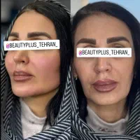 ساکشن غبغب وتزریق چربی بصورت و هرناحیه ازبدن درمطب|خدمات آرایشگری و زیبایی|قم, زنبیل آباد|دیوار