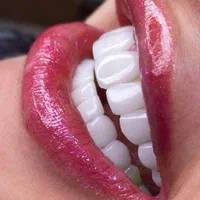 جشنواره پاییزه کامپوزیت، لمینت،روکش.دندان مصنوعی