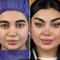 بوتاکس،لیفت شقیقه،دایرکت ابرو،سابرولیف