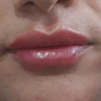 تزریق فیلر وبوتاکس