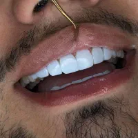 کامپوزیت دندان ازدم قسط بدون پیش پرداخت